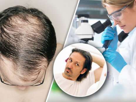 Hair Loss Treatment and Products