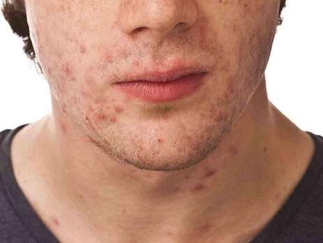 What Reason Acne in Adolescents & Adults?