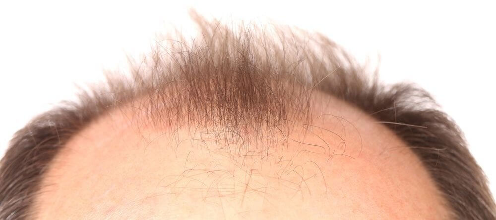 About-Hair-Loss