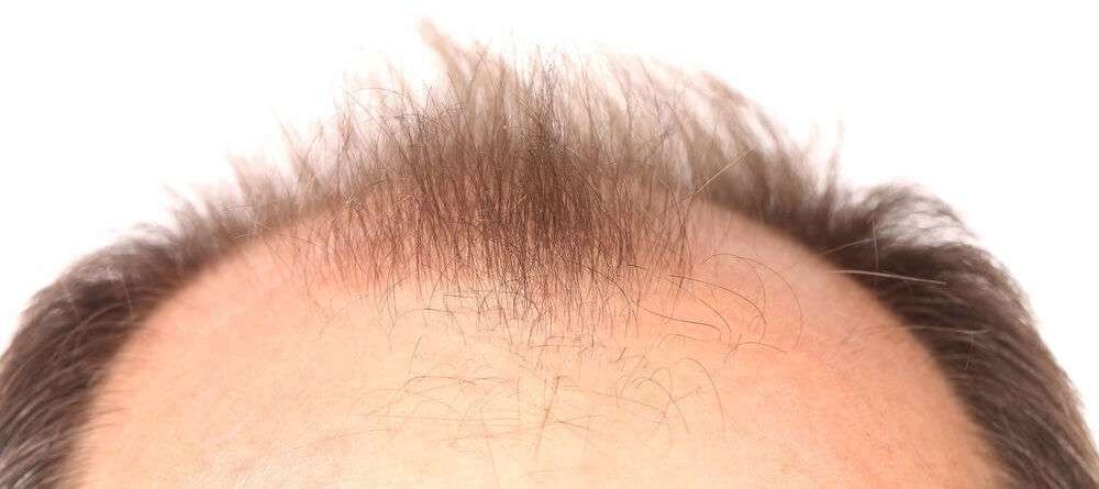 About Hair Loss!
